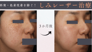 しみ　レーザー治療