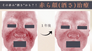 赤ら顔（酒さ）治療