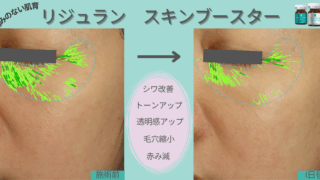 リジュラン スキンブースター 導入