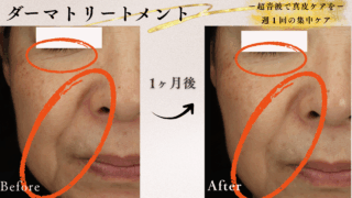 ダーマトリートメント