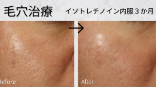 毛穴治療〈イソトレチノイン内服〉