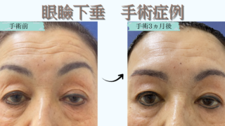 眼瞼下垂手術　症例①（経過編）
